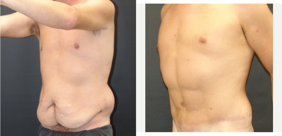 Man treated with Abdominal Etching