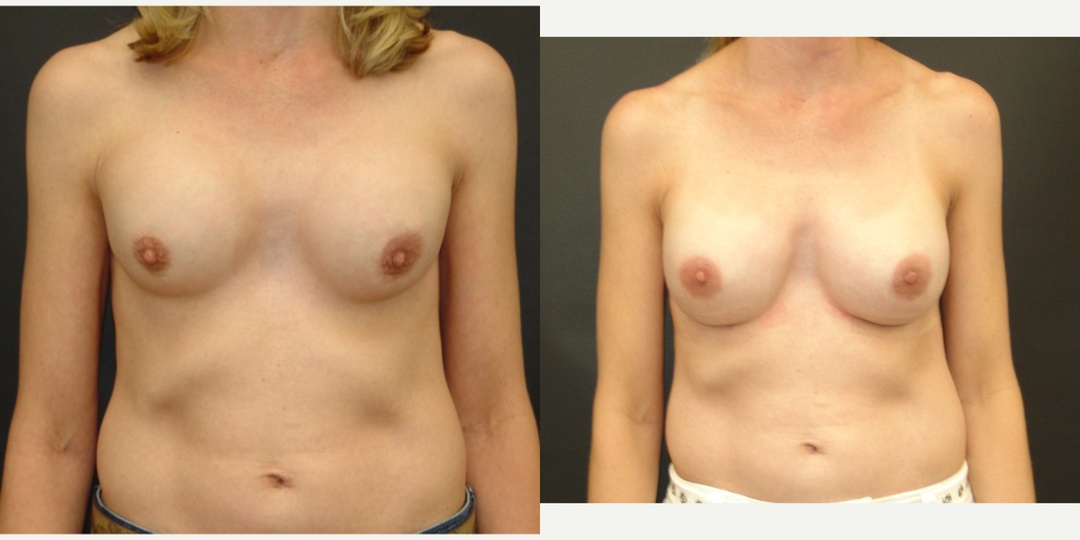 Woman treated with Breast Implant Revision