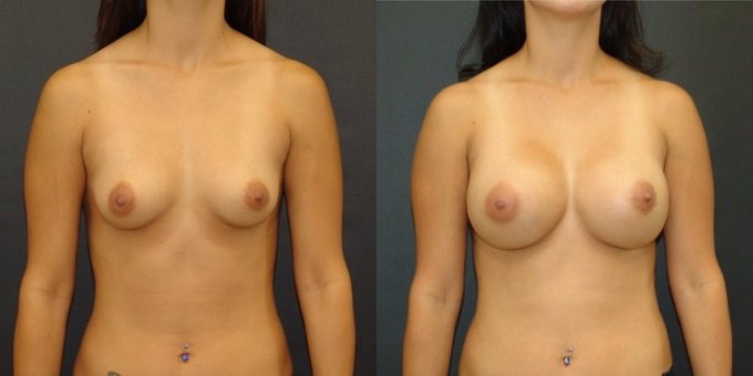 Woman treated with Breast Implants