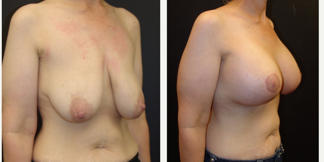 Woman treated with Breast Lift With Implants