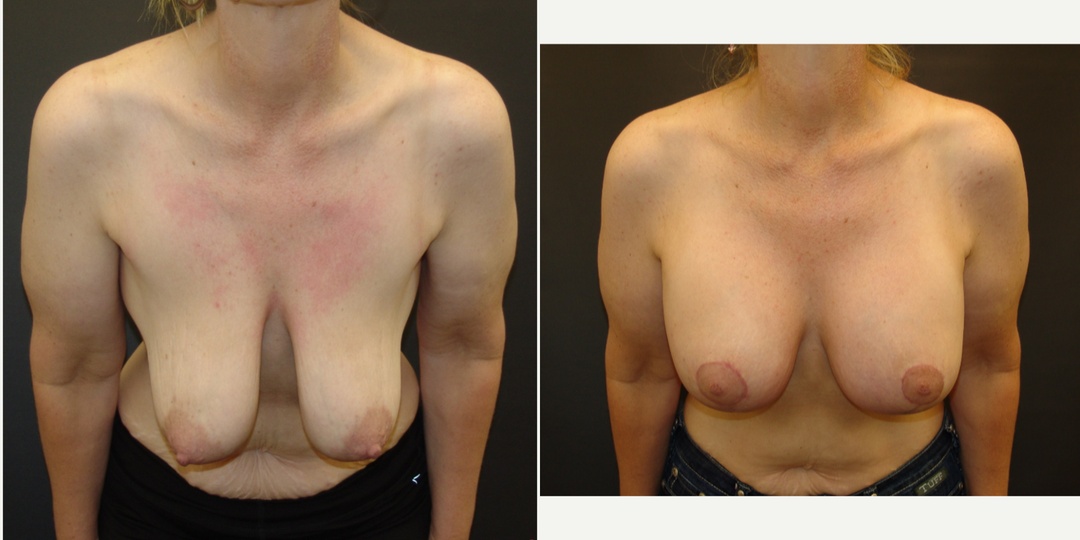 Woman treated with Breast Lift With Implants
