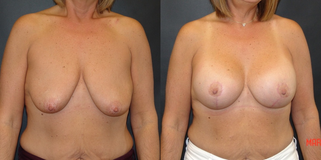 Woman treated with Breast Lift With Implants