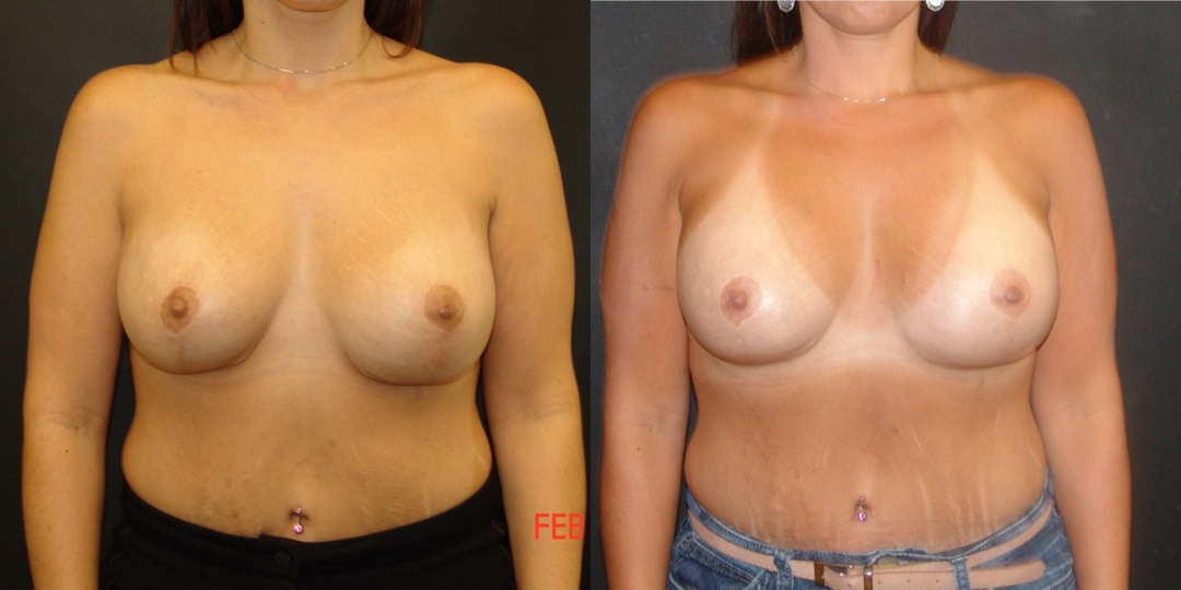 Woman treated with Breast Lift With Implants