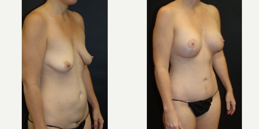 Woman treated with Mommy Makeover