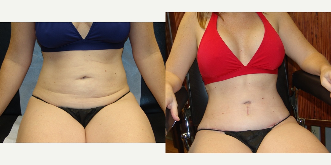 Woman treated with Mommy Makeover