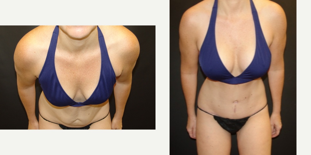 Woman treated with Mommy Makeover