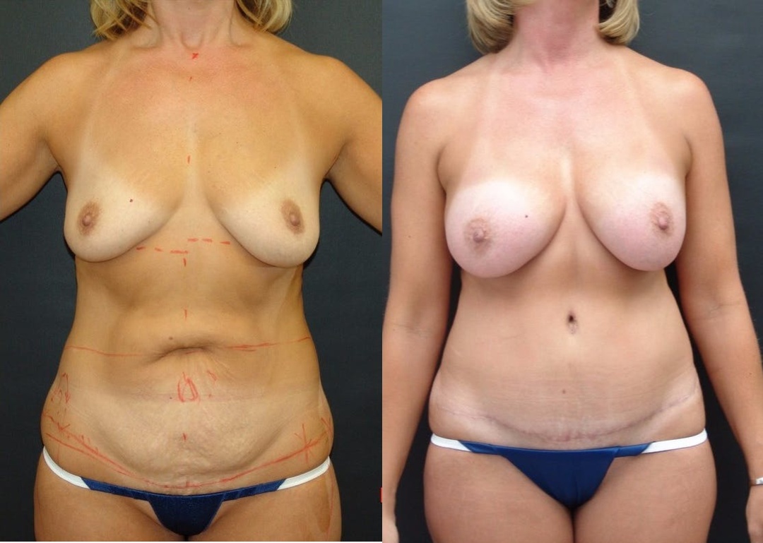 Woman treated with Mommy Makeover