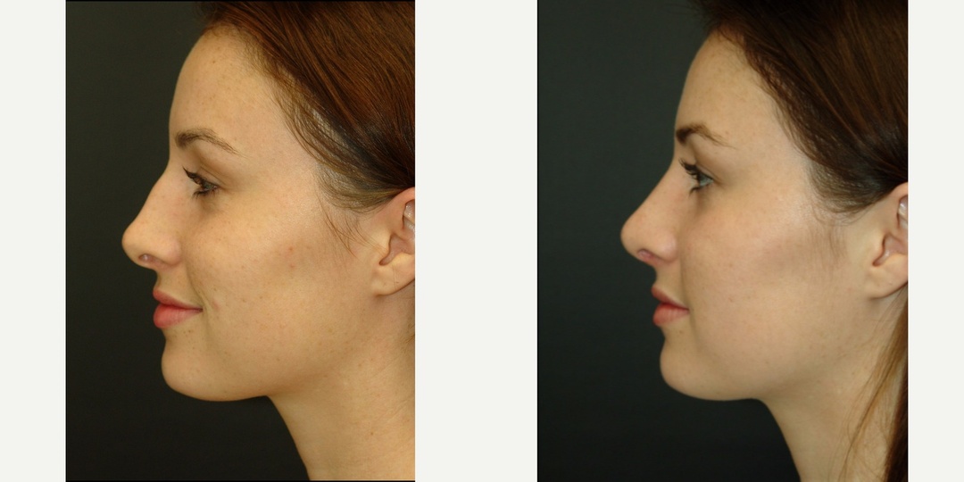 Woman treated with Rhinoplasty