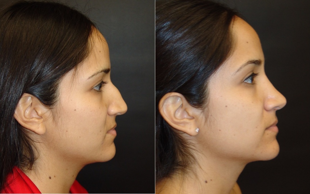 Woman treated with Rhinoplasty