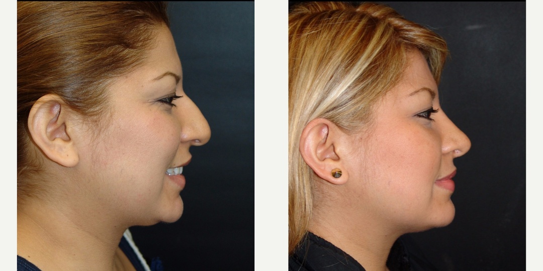 Woman treated with Rhinoplasty