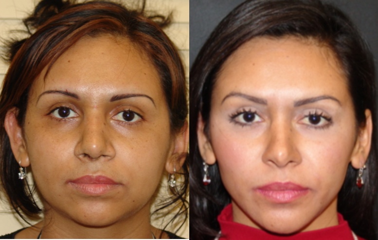 Woman treated with Rhinoplasty