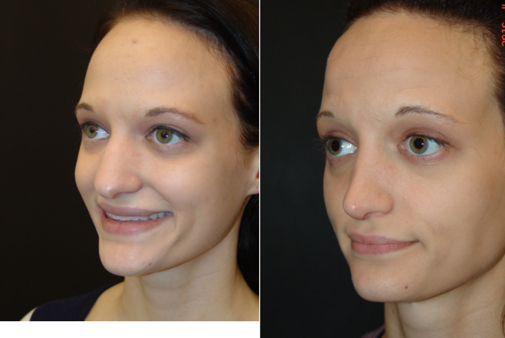 Woman treated with Rhinoplasty
