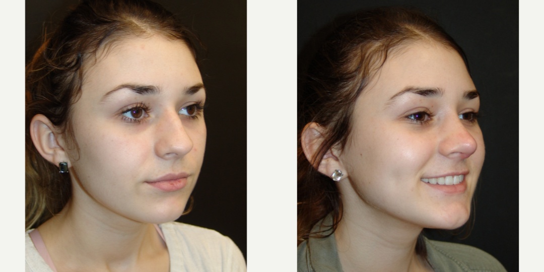 Woman treated with Rhinoplasty