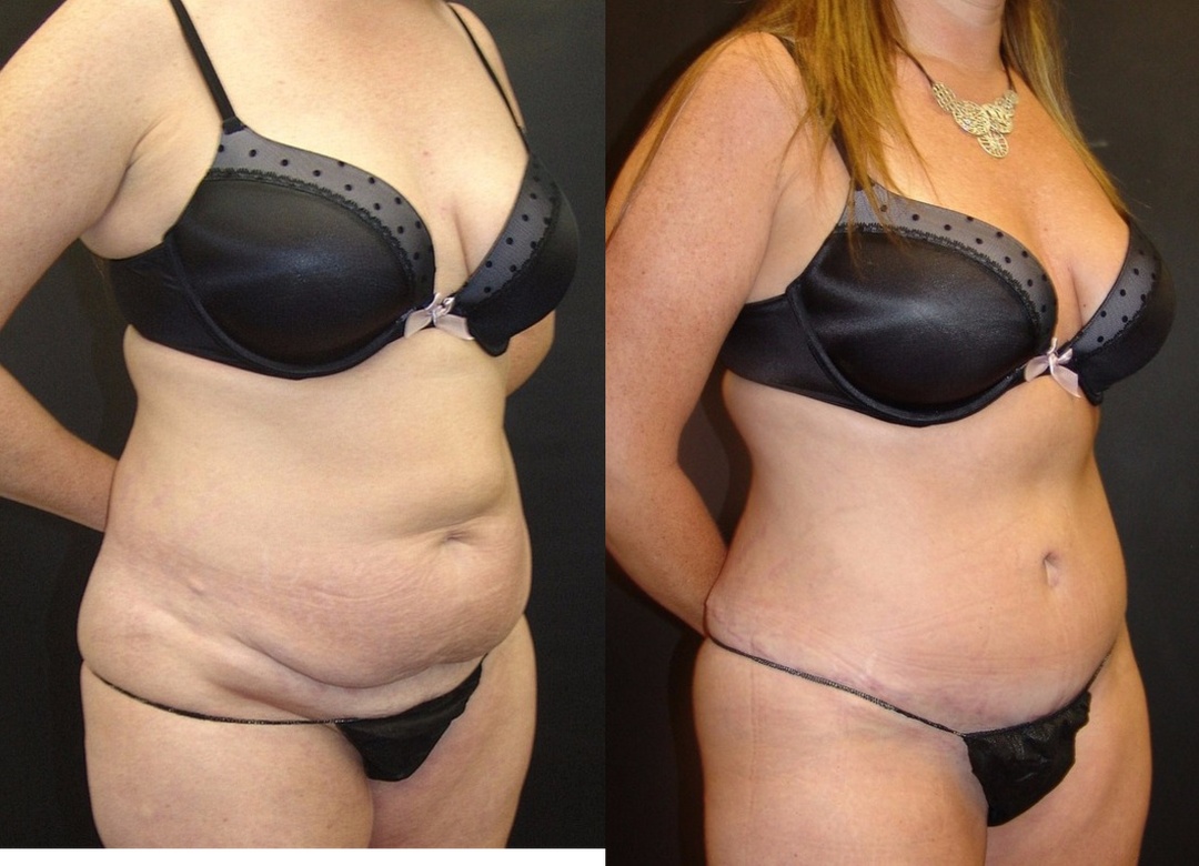 Woman treated with Tummy Tuck