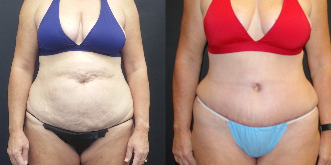 Woman treated with Tummy Tuck