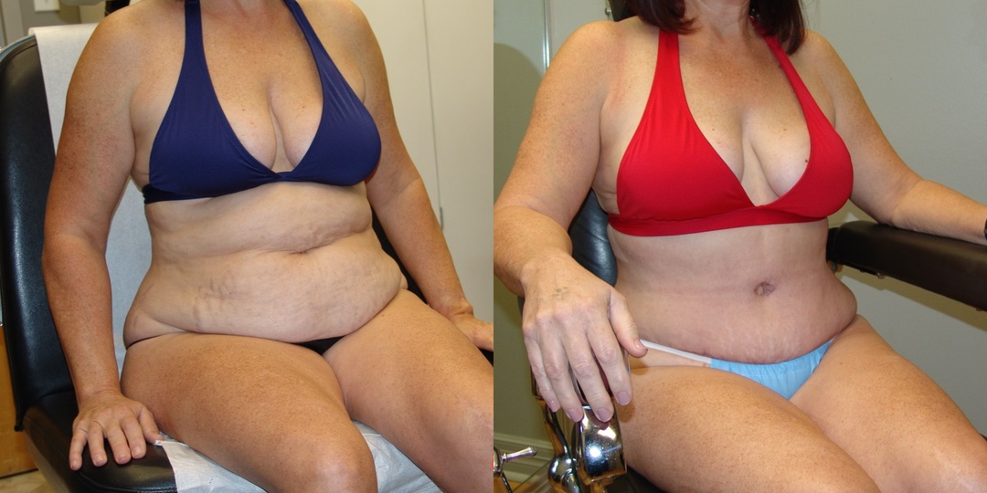 Woman treated with Tummy Tuck