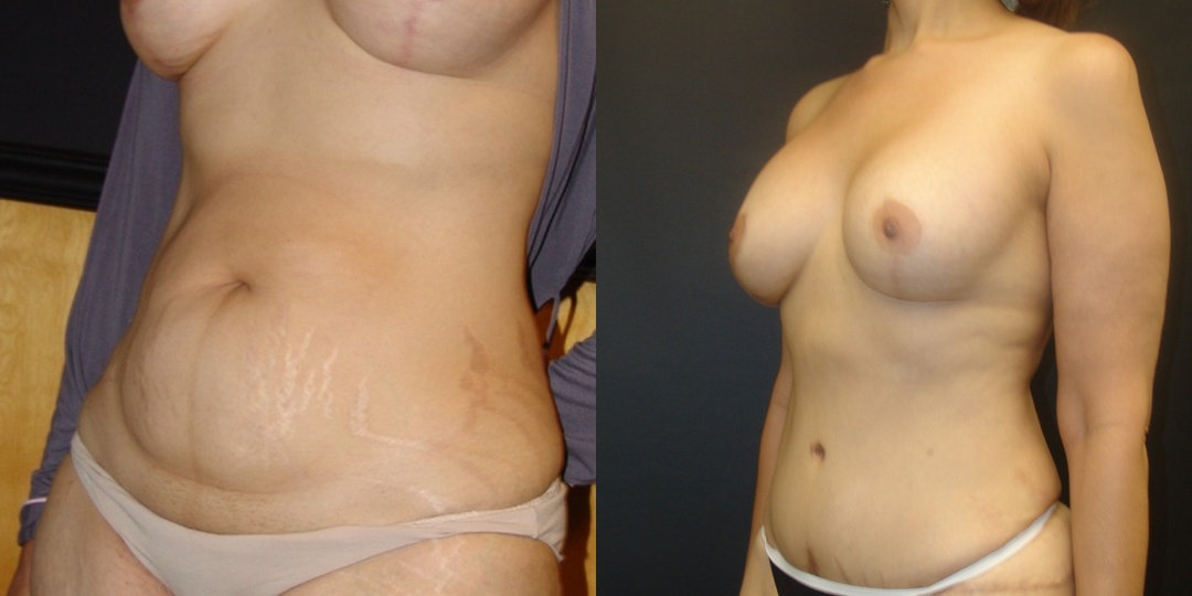 Woman treated with Tummy Tuck
